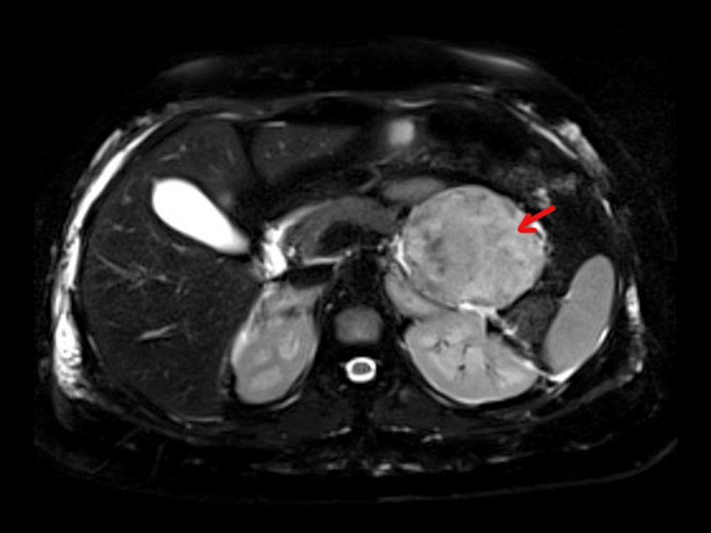 MRI abdomen T2-weighed images axial image showing a pancreatic mass, most likely a neuroendocrine tumor, with adrenal hyperplasia (indicated by arrow).