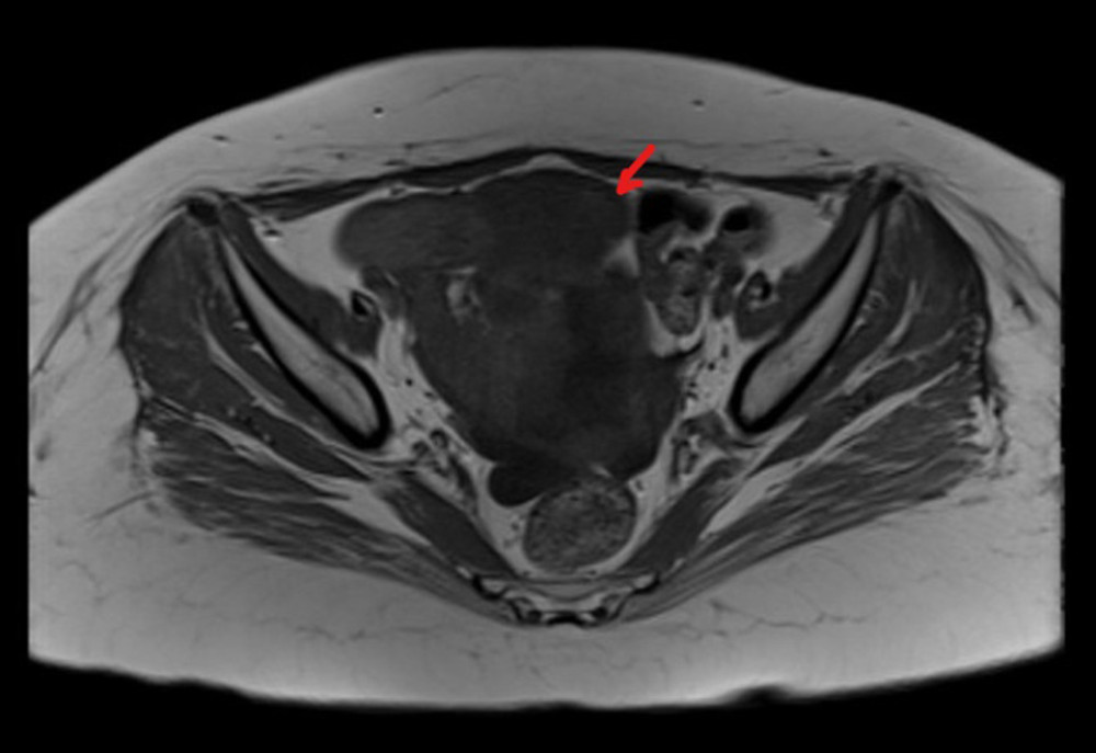 MRI abdomen T2-weighed image coronal image showing a pancreatic mass, most likely a neuroendocrine tumor, with adrenal hyperplasia (indicated by arrow).