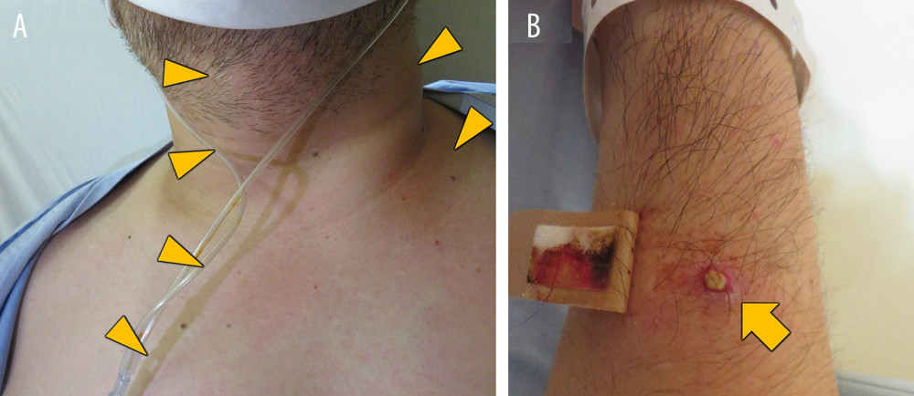 Physical examination findings on day 14 of hospitalization. On physical examination, redness and swelling were noted in the neck area, which the patient reported as painful (triangle) (A). Pus was present around the insertion site of the peripheral catheter (arrow) (B).