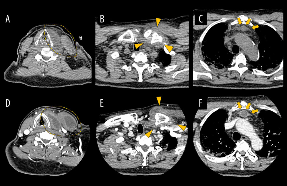 Computed tomography of the neck on day 14 (A–C) and day 17 (D–F) of hospitalization. Plain computed tomography (CT) on day 14 of hospitalization showing enhanced soft tissue shadows (A) in the left sternocleidomastoid muscle and the left strap muscles (dot area), (B) around the left sternoclavicular joint (triangle), and (C) in the superior mediastinum (arrow). (D) Contrast-enhanced CT on day 17 of hospitalization showing abscess formation in the left sternocleidomastoid muscle and the left strap muscles (dot area). (E) The left sternoclavicular joint shows an increased concentration of surrounding adipose tissue without bone destruction (triangle). (F) The abscess has also reached the superior mediastinum on the dorsal side of the sternum (arrow).