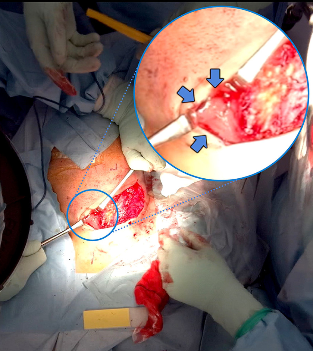 Pus drainage during surgery. The magnified anterior cervical wound is shown (blue circle). Grayish white pus with a foul odor was discharged after making an incision on the strap muscle (blue arrow). Pus drainage was also observed after the incision of the sternocleidomastoid muscle.