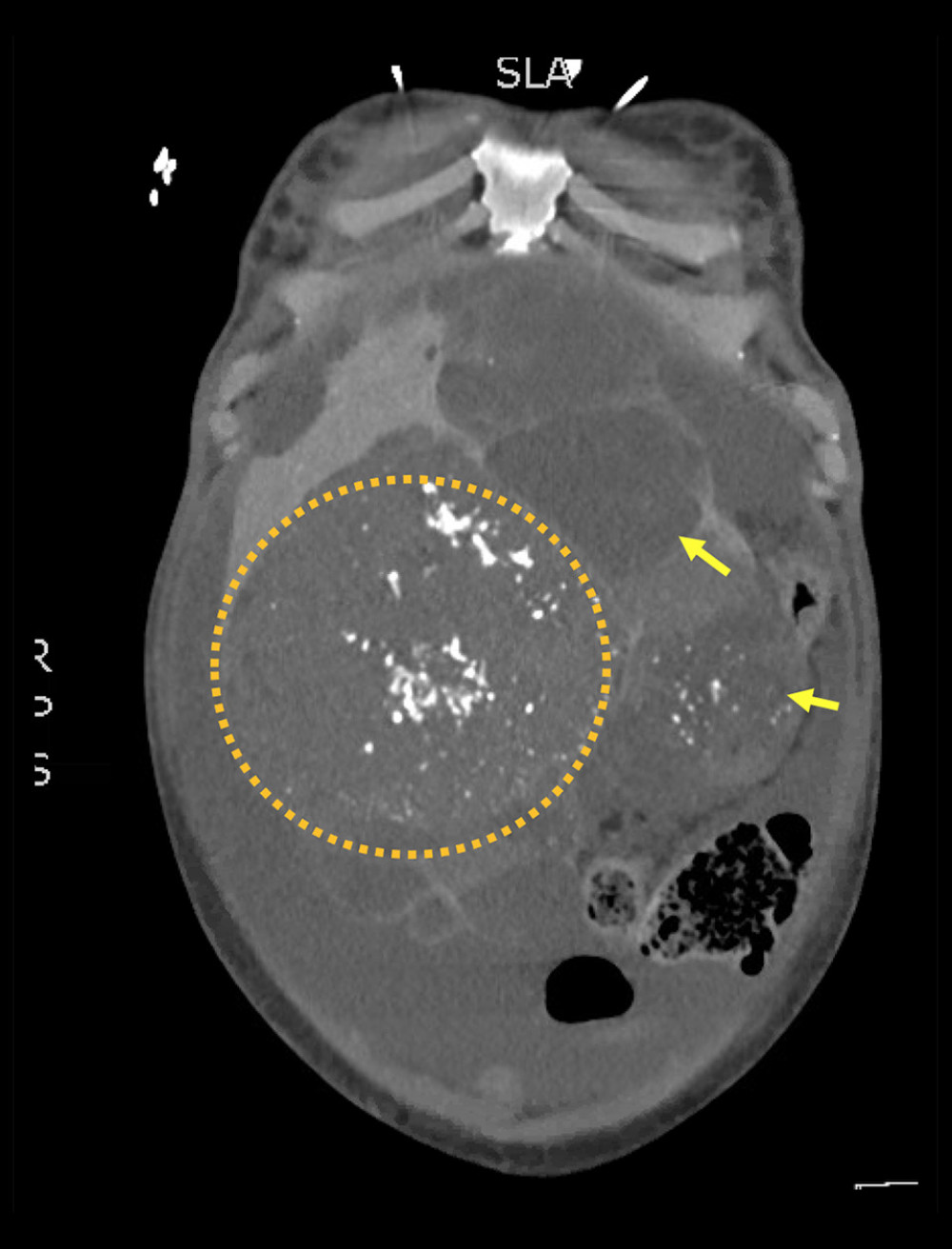 Coronal view of a computed tomography scan showing multiple hepatic hemangiomas (arrows). Largest one measure 14.3×14.6×14.9 cm (circle).