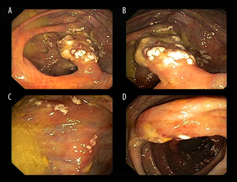 Endoscopic aspect: confluent whitish lateral-spreading lesions with a round pit-pattern in white-light HD scope. (A) Cecum and ileocecal valve. (B) Cecum/ascending colon transition. (C) Cecum. (D) Ascending colon.