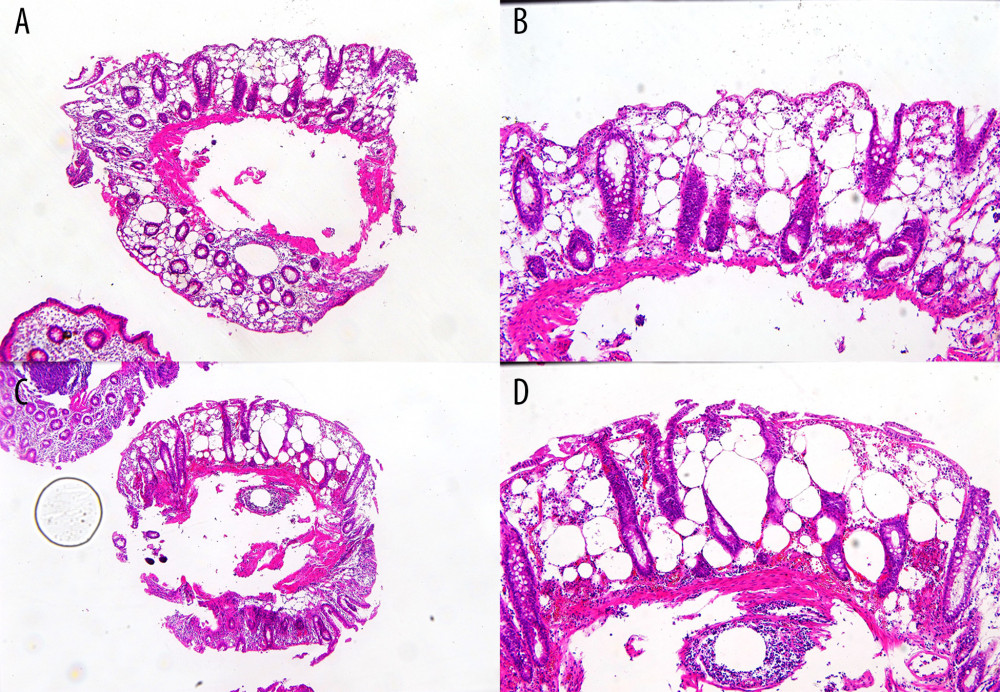 Histopathologic analysis revealed multiples cysts filled with gas, within the mucosal layer, associated with a mild inflammatory process, mainly composed of mononuclear cells and eosinophils. Architectural organization and tissue maturation were preserved with no nuclear atypia, consistent with a diagnosis of colonic pseudolipomatosis (hematoxylineosin stain). (A) 4×. (B) 10×. (C) 2×. (D) 20×.