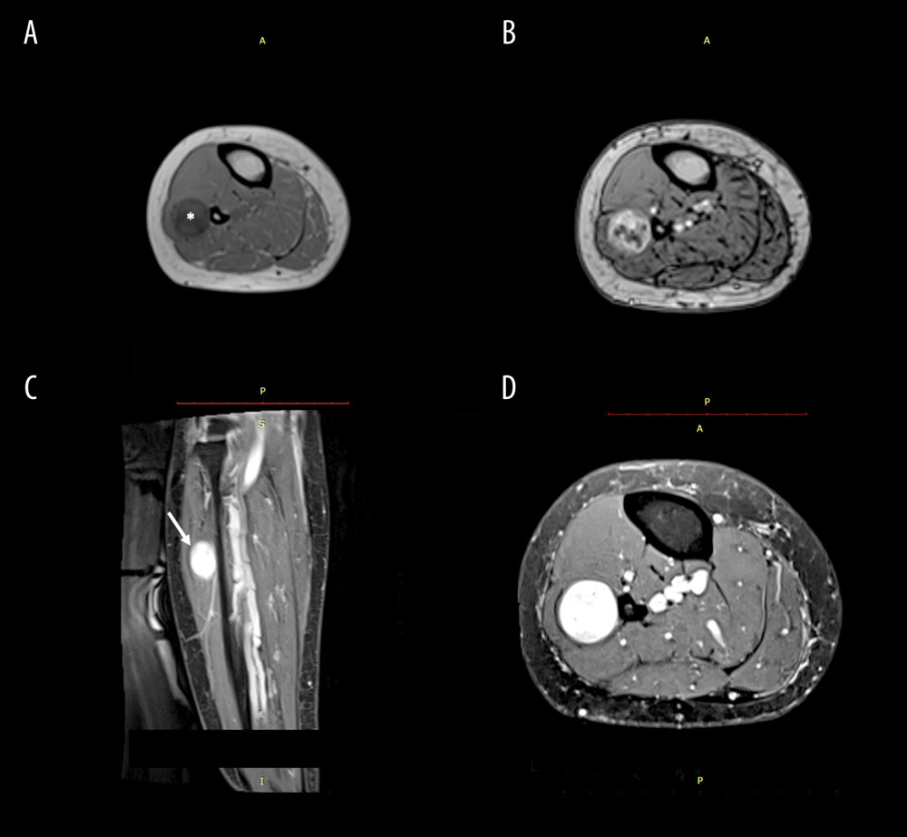 Magnetic resonance imaging (MRI) of the patient’s right leg. A well-defined, oval shaped lesion visible just lateral to the fibula at the proximal third of the right leg. (A) Iso-hypointense signal on axial T1-weighted image without contrast (asterisk). (B) Heterogeneous enhancement on T1-weighted image with intravenous contrast. (C) Sagittal view on T1-weighted image with contrast showing lesion (arrow) arising from the superficial peroneal nerve. (D) Clear visualization of the lesion measuring 2 cm in width on proton-density sequence.