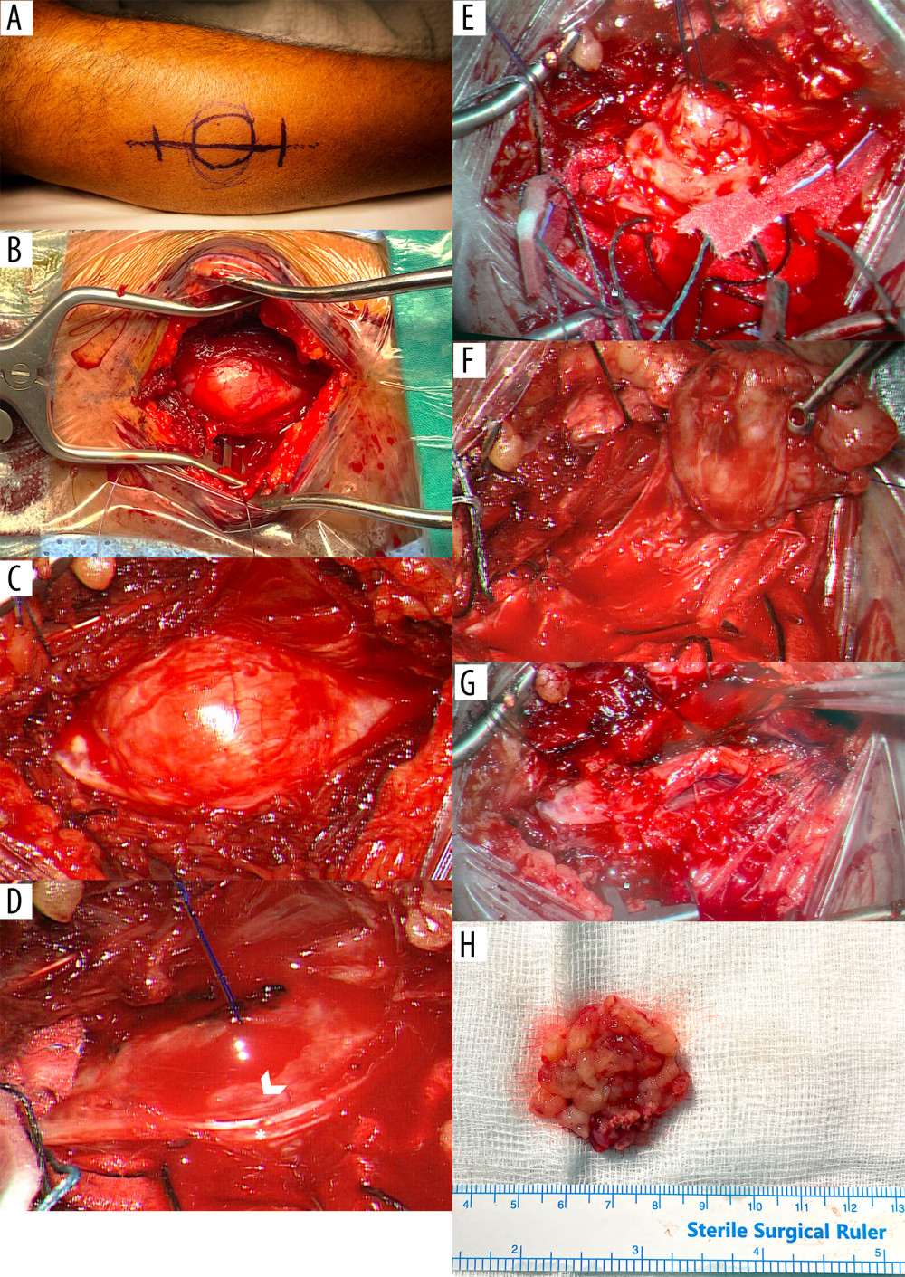 Sequential perioperative findings. Surgical excision of patient’s right upper leg tumor under microscopy. (A) Antero-lateral approach. Tumor borders defined via clinical examination and a horizontal skin incision marked. (B) Gross visualization of the lesion. (C) Microscopic visualization of the lesion. (D) Superficial peroneal nerve fascicles identified (asterisks) and was attached to the tumor (arrowhead). (E, F) Tumor exposition, dissection and enucleation performed. (G) Superficial peroneal nerve (asterisk) after excision of the tumor, with capsule left behind and epineurium sutured. (H) Gross appearance of the tumor measuring 3.5×2.0×1.0 cm.