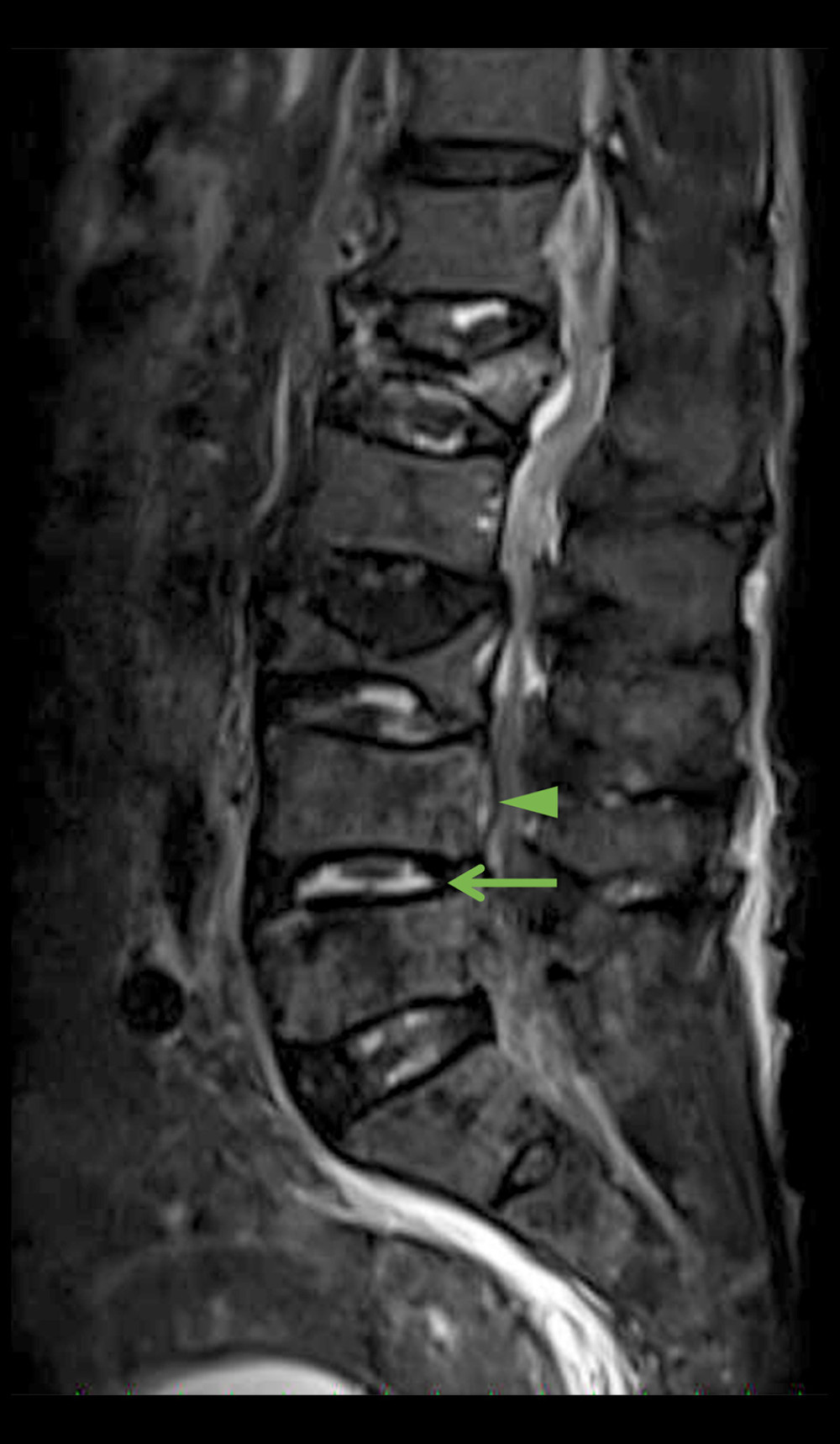 Sagittal magnetic resonance imaging, short T1 inversion recovery sequence, demonstrates hyperintensity within the disk of L4/5 (arrow) and L4 vertebral body (arrowhead).