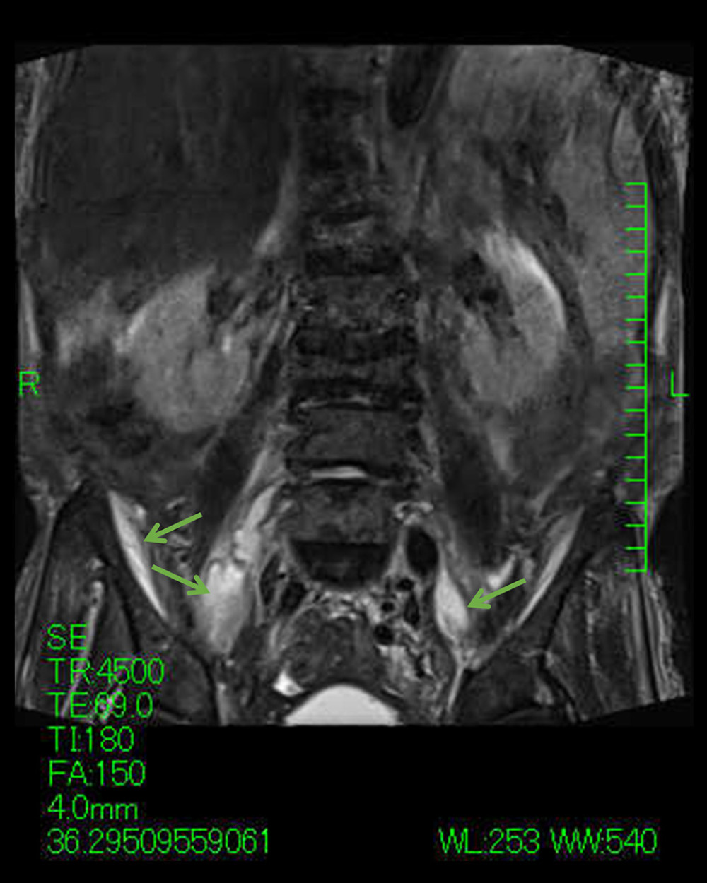 Coronal magnetic resonance imaging, short T1 inversion recovery sequence, demonstrates bilateral fluid retention in the psoas muscles and retroperitoneal space, suggesting abscesses (arrows).