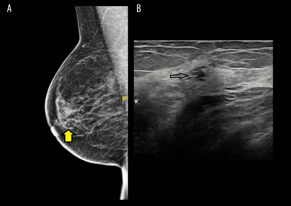 (A) Mammogram with mediolateral oblique view (MLO) that shows the partially obscured breast mass, denoted by the arrow. (B) Ultrasound confirms the findings of the mammogram in Figure 1A.