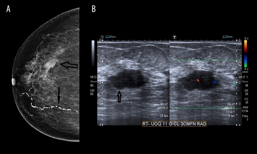 (A) Mammogram with craniocaudal (CC) view demonstrates the poorly defined mass on a background of fatty breast tissue (large arrow) and vascular calcification (small arrow). (B) Ultrasound confirms the findings of the mammogram in Figure 2A.