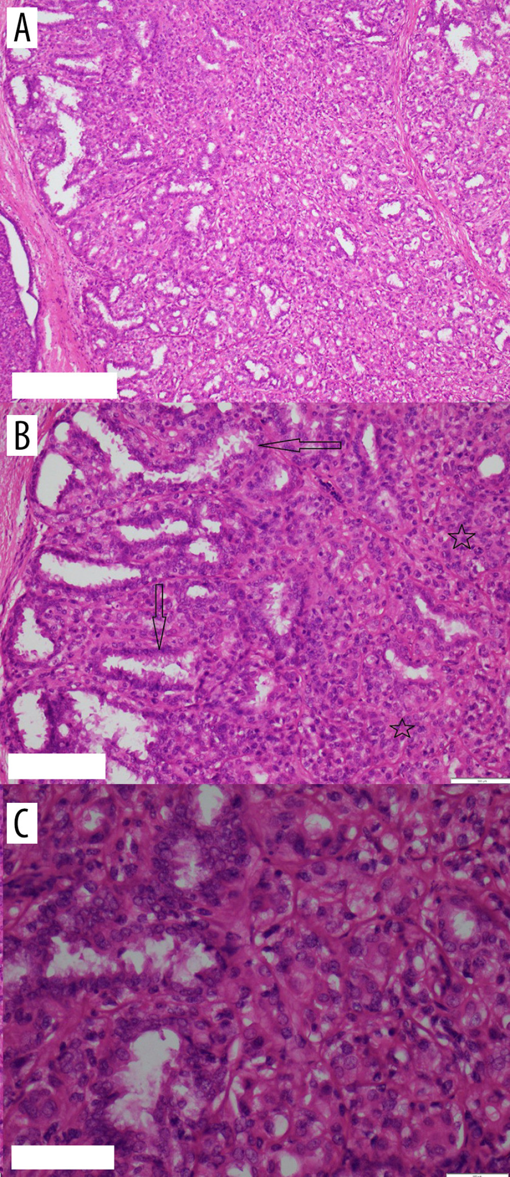 (A) H&E ×10; (B) H&E ×20; (C) H&E ×40, showing a biphasic tumor composed mainly of myoepithelial cells surrounding epithelial-lined spaces.