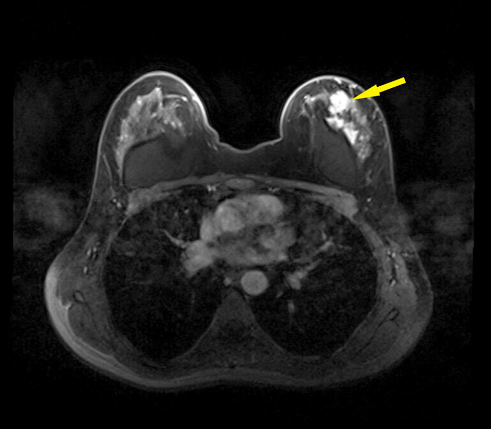 MRI shows a well-defined mass with a concomitant diffuse lesion on the surface of the intact implant on the left breast, denoted by the arrow.