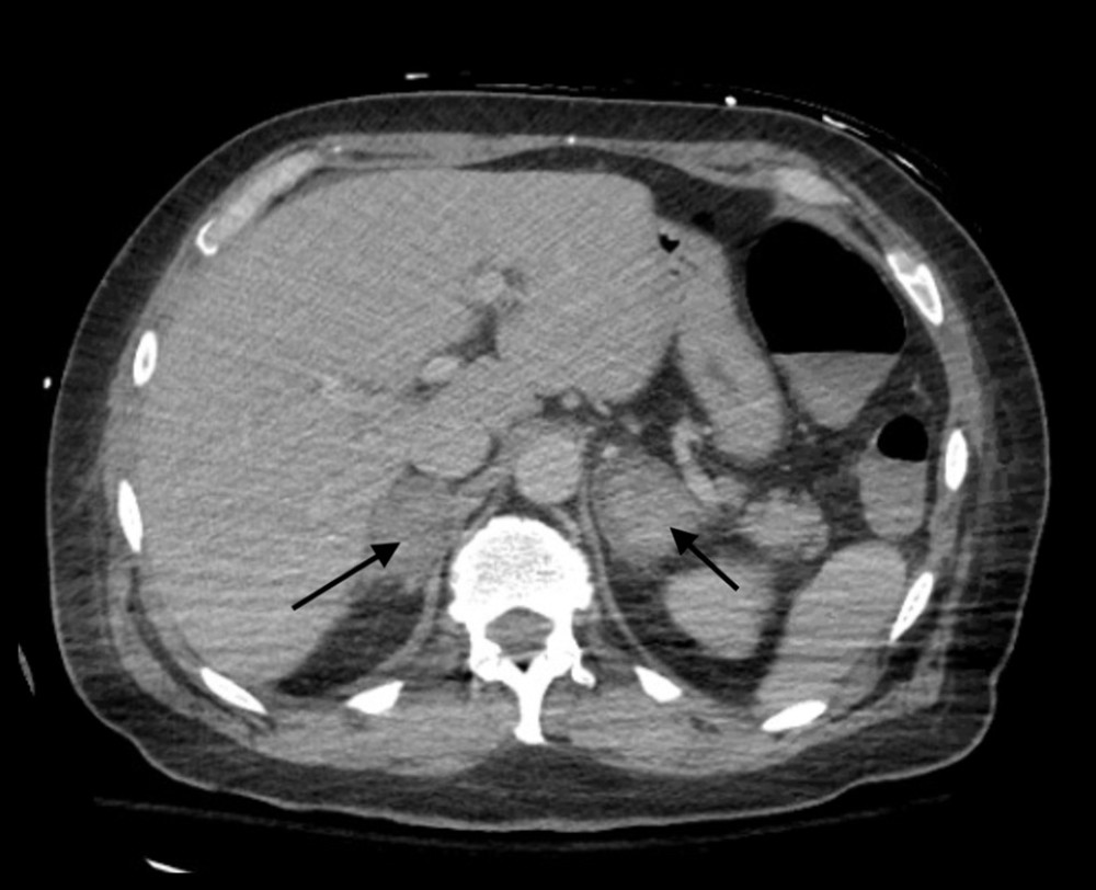 Contrast-enhanced computed tomography (CT) imaging of the abdomen and pelvis, revealing bilateral adrenal hemorrhages (arrows).