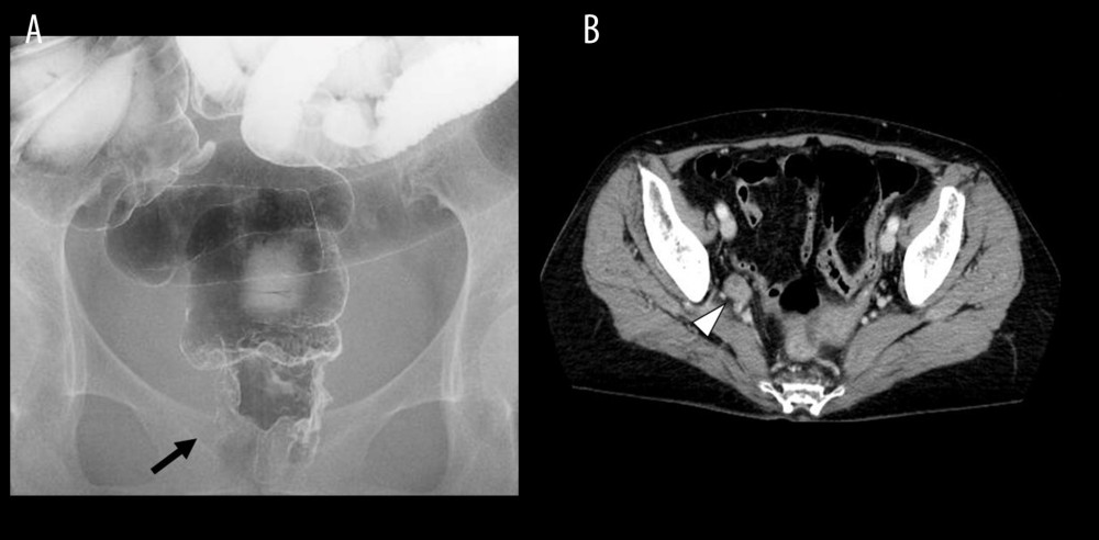 Preoperative imaging of rectal cancer and lymph node metastasis. (A) Barium enema imaging revealed a 7-cm, type 2, circumscribed lesion extending from the lower rectum through the anal canal (arrow). (B) A contrast-enhanced computed tomography scan of the pelvic area showed rectal cancer located mainly on the posterior wall, with metastasis present at the right lymph node (white arrowhead).