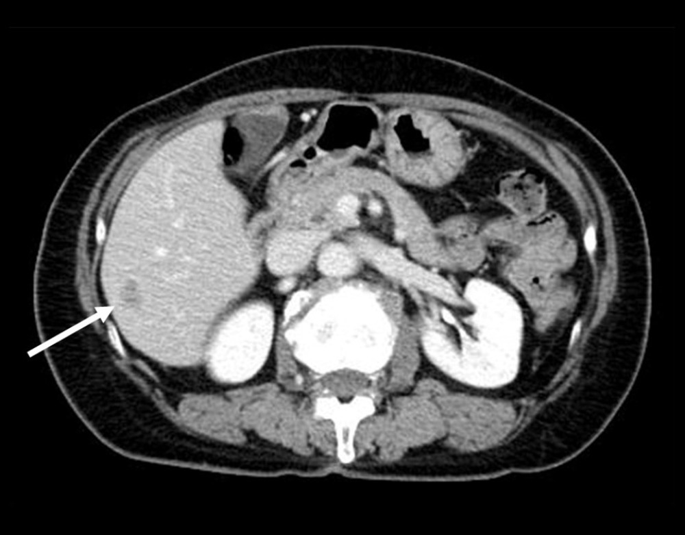 Preoperative imaging of metastatic liver lesion. Contrast-enhanced computed tomography scan of the upper abdomen showed a 3-cm metastatic tumor of the liver (segment 6 of the liver; arrow). (This finding was similar to the ultrasound and magnetic resonance imaging findings).