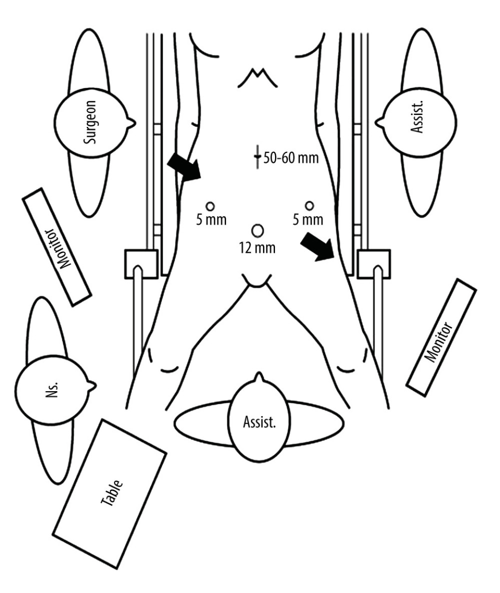 Diagram of location of ports and incision used in resecting the primary lesion. Arrows indicate the surgeon’s line of sight for arranging ports from the lower abdomen to the pelvic floor for the hand-assisted laparoscopic surgery procedure.