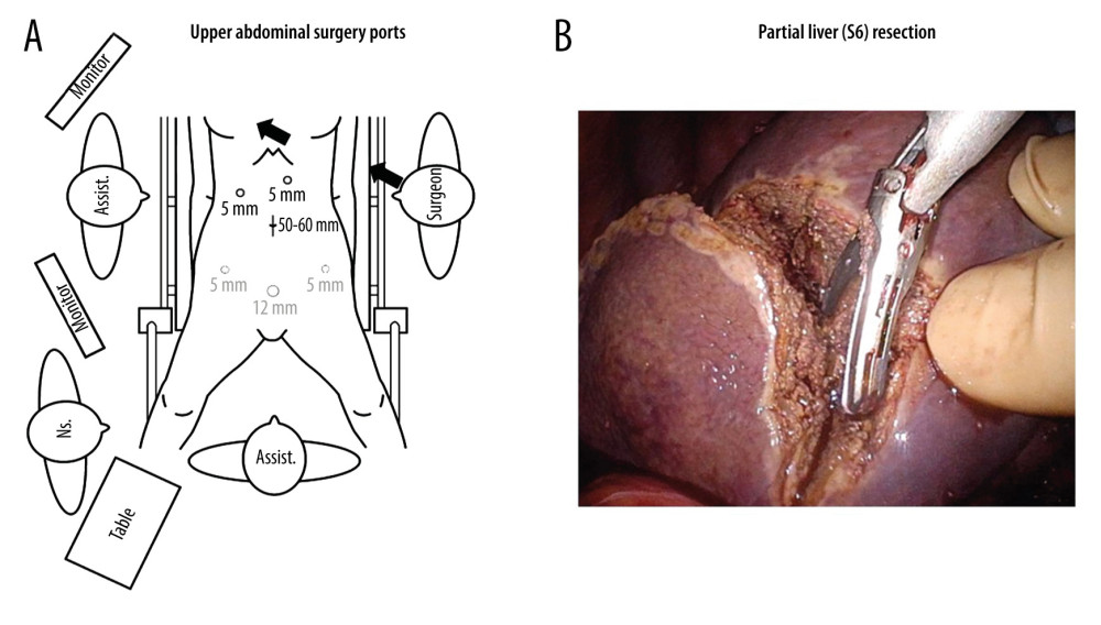 Upper abdominal surgery for partial resection of the liver (segment 6 of liver). (A) Diagram of port arrangement, with arrows indicating the surgeon’s line of sight. (B) A 3-cm metastatic tumor in the liver (segment 6 of liver) was confirmed by intraoperative ultrasound and palpation. The intraprocedural photograph shows partial hepatic resection performed with an ultrasonic coagulator.
