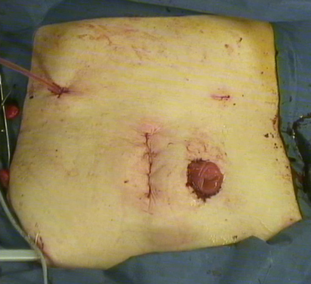 Photograph of the postoperative abdomen. A drain was placed by using the port insertion sites in the upper right (under the right diaphragm) and lower right (pouch of Douglas) abdominal areas. A permanent artificial anus was constructed in the lower left abdomen.