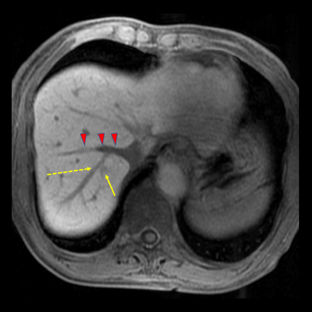 Gadolinium-ethoxybenzyl-diethylenetriamine pentaacetic acid-enhanced (GD-EOB-DTPA) magnetic resonance imaging (MRI) of segment VII. The metastatic tumor (arrow) was located beside the root of the hepatic vein (V7; dotted line), which connects to the right hepatic vein (arrowhead).