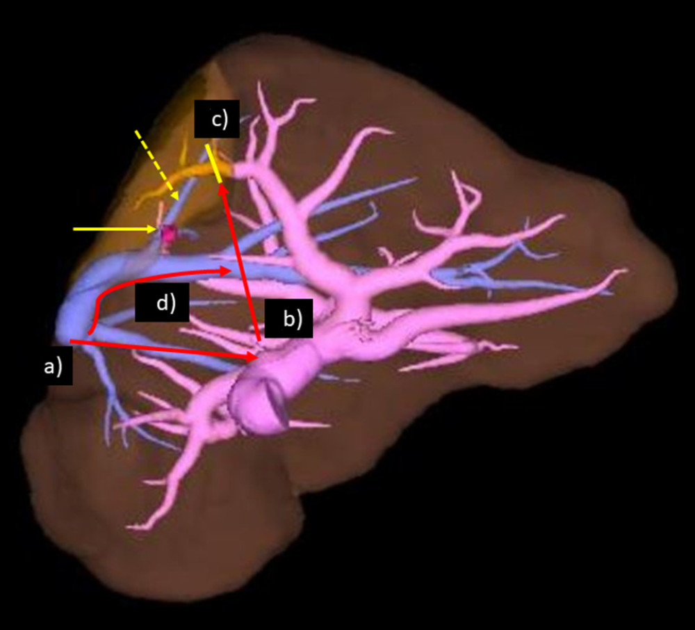 Thematic surgical strategy for the metastasis in segment VII (3-dimensional (3D) image made in SYNAPSE VINCENT®, 3D medical image analysis system using Fujifilm image recognition technology to construct 3D images compiled from CT, FUJIFILM Corporation, Tokyo, Japan) (right lateral view). The hepatic vein of segment VII (V7) (dotted line) was set as the anatomical landmark and identified in intraoperative echography. Surgical procedure: a) As recognition of the root of right the hepatic vein and hepatic hilum, discriminate between the caudate lobe (paracaval portion) and segment VII. b) Resect liver parenchyma from caudal of V7. c) Transect the peripheral Glissonean pedicle of segment VII. d) Expose the right hepatic vein from the root to peripheral. Arrow: metastatic tumor.