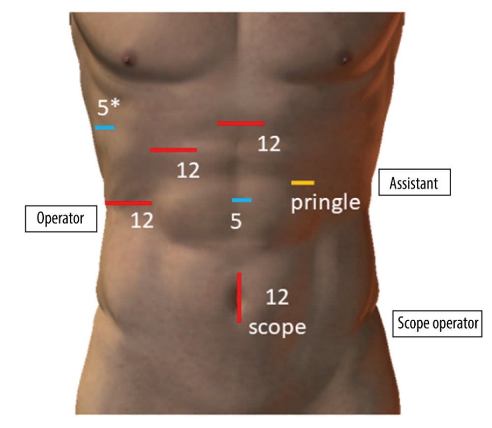 Trocar placement. The operator stood to the right of the patient, and the assistant and scope operator to the left. Number: trocar size (mm), * intercostal trocar in the 10th space.