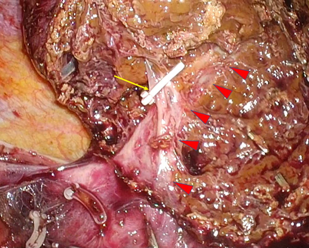 Transection plane of segment VII (right lateral view). The right hepatic vein (arrowhead) was exposed. Arrow: V7, which was set as the anatomical landmark before surgery.