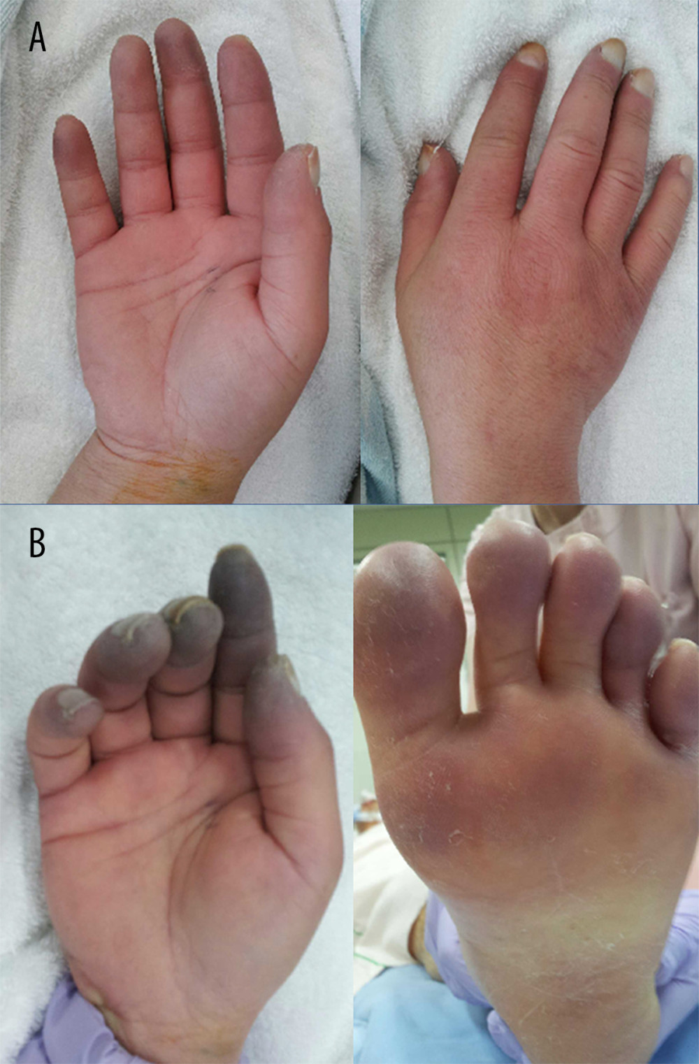 The patient’s hand and sole at (A) admission and (B) on day 12. (A) The patient’s hand exhibited purpura that extended to the tips as well as skin sclerosis on fingertips. (B) The ischemic lesion on his fingers were exacerbated and purpura on his sole revealed.