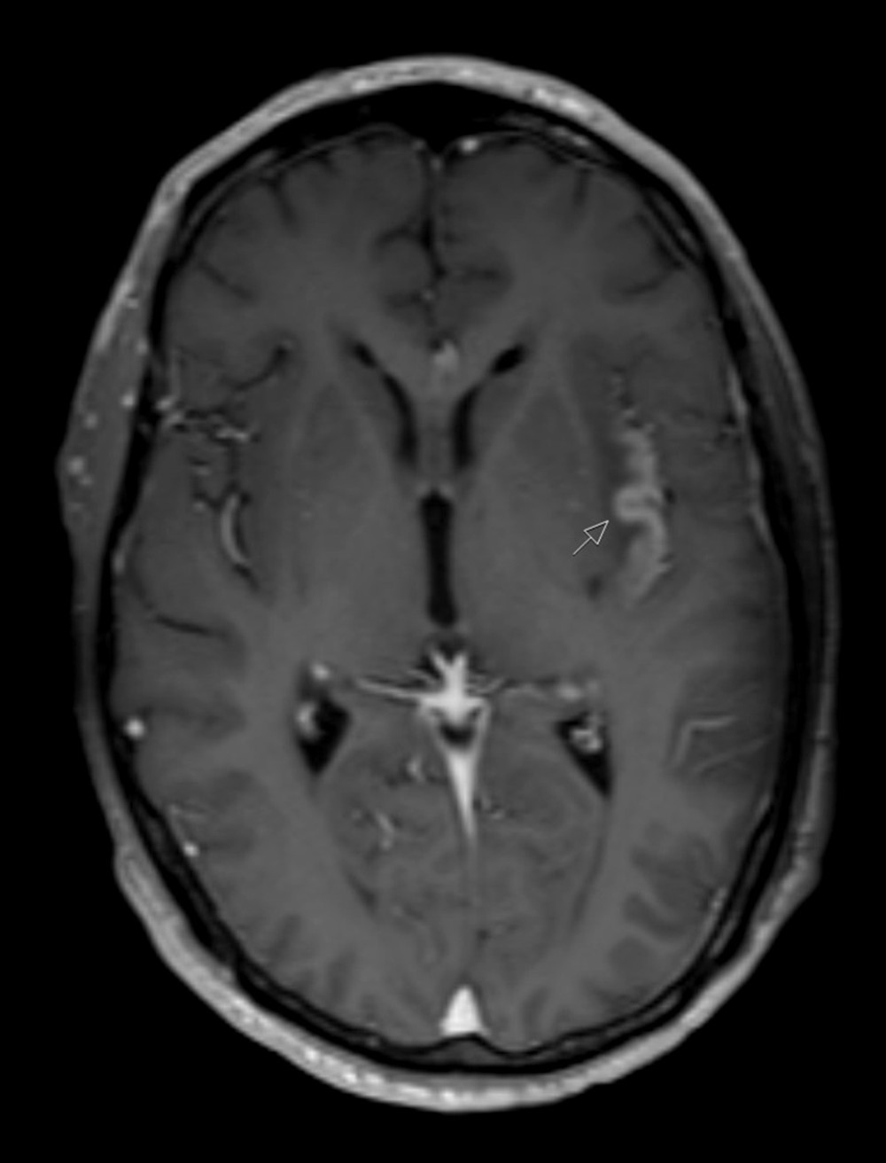 First axial contrast-enhanced T1-weighted magnetic resonance imaging (MRI), showing enhancement along the left insular lobe, particularly of the insular cortex (arrow).