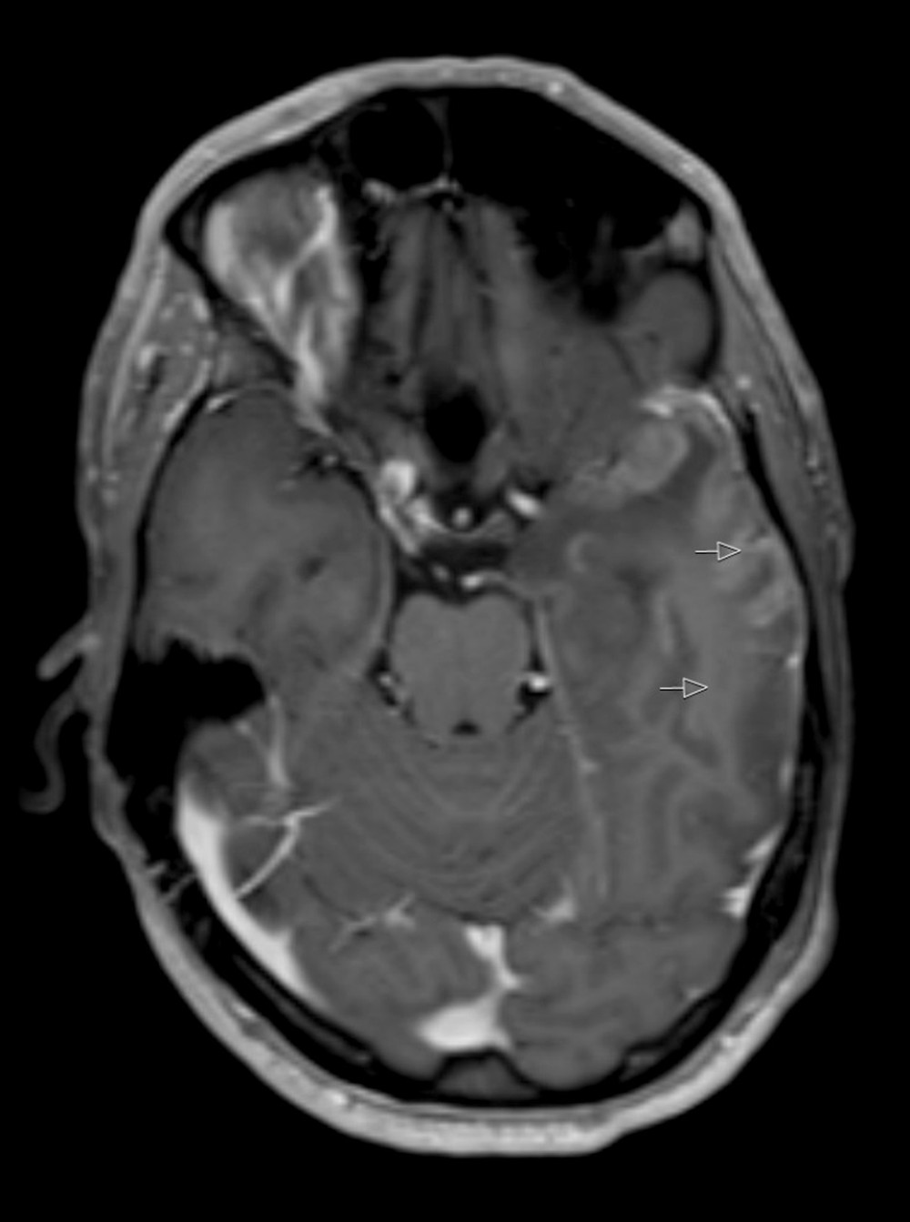 First axial contrast-enhanced T1-weighted MRI, showing hyperintense signal areas diffusely in the white matter in the left temporal lobe, with cortical contrast enhancement along the lateral and anterior-medial-basal parts of the left temporal lobe (arrows). Similar but less prominent changes are seen in the right temporal lobe. The interruption of the anatomical continuity of the lateral aspect of the right temporal lobe is an artifact.