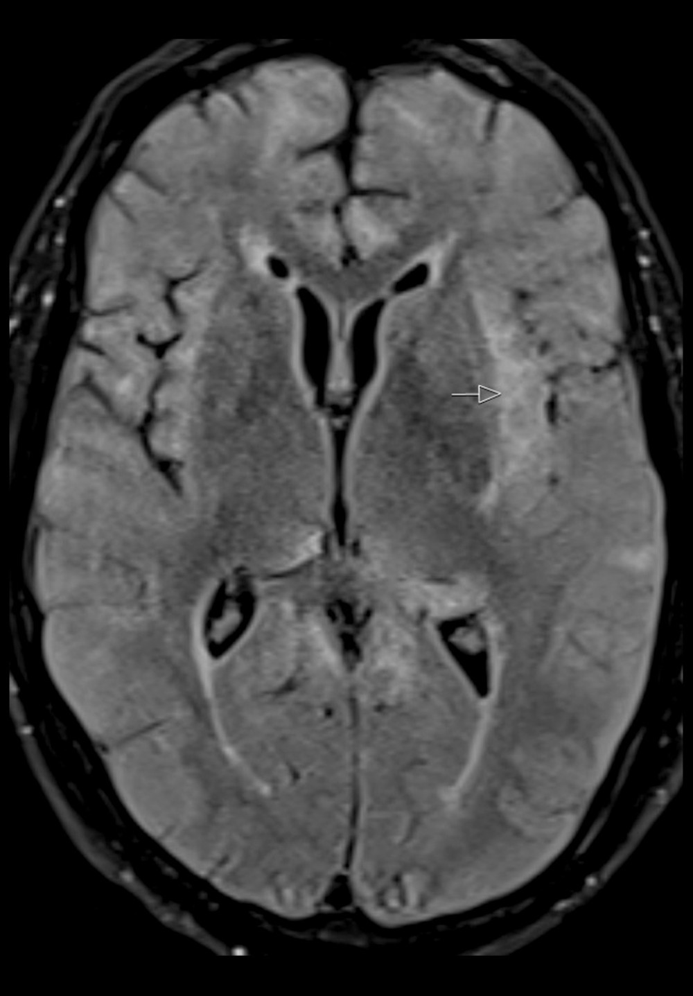 First axial FLAIR-weighted MRI showing hyperintense signal areas along the left insular lobe (arrow). Similar but less prominent changes are seen in the right insular lobe. A hyperintense signal is seen in the cingulate gyrus, bilaterally, as well as in frontal poles, more intense on the right.