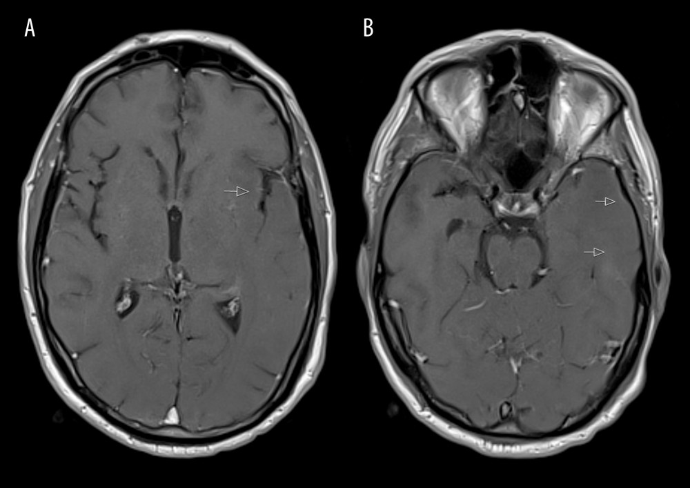 (A, B) Second axial contrast-enhanced T1-weighted MRI showing a marked decrease in the previously observed changes (arrows). In addition, a hypointense signal is observed in the medial surface of the frontal cortex, bilaterally (A).