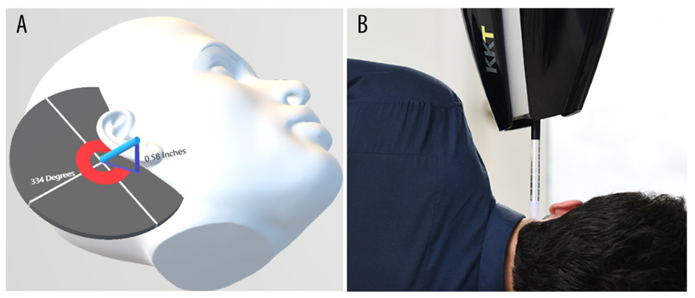 (A) 3D model displaying vector of probe (blue) as applied to the patient. Treatment was applied at an angle of 334° and elevated at 0.58 inches. (B) Reference image displaying how the wave treatment is applied to the patient. Images are for diagrammatic purposes only, and angles and distances are not accurately illustrated.