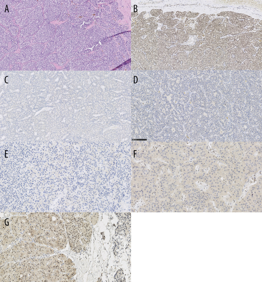 Staining for parafibromin in group of patients with brown tumors. (A) Physiological hematoxylin eosin staining of healthy parathyroid gland. (B) Physiological parafibromin staining of healthy parathyroid gland. (C) Primary hyperparathyroidism and brown tumors in ribs in patient 2. (D) Primary hyperparathyroidism and multiple brown tumors in ribs, pelvis, lower limbs, and mandibula in patient 3. (E) Primary hyperparathyroidism and brown tumor in sternum in patient 4. (F) Recurrent primary hyperparathyroidism and multiple brown tumors in lower and upper limbs in patient 1. (G) Primary hyperparathyroidism, multiple brown tumors in lower and upper limbs, and severe bone deformities in patient 4.