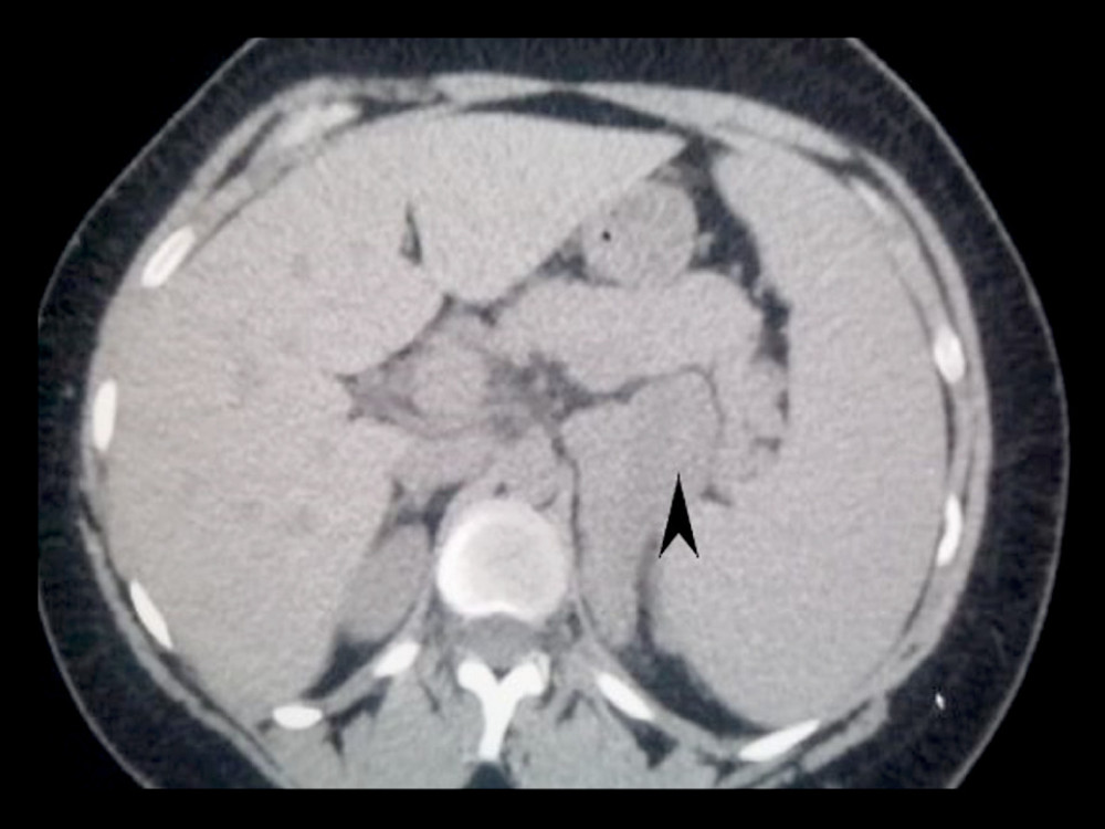 Axial abdominal computed tomography scan showing a large triangular (7.0×4.0×4.8 cm) complex mass of solid and relatively cystic components in the left suprarenal region.