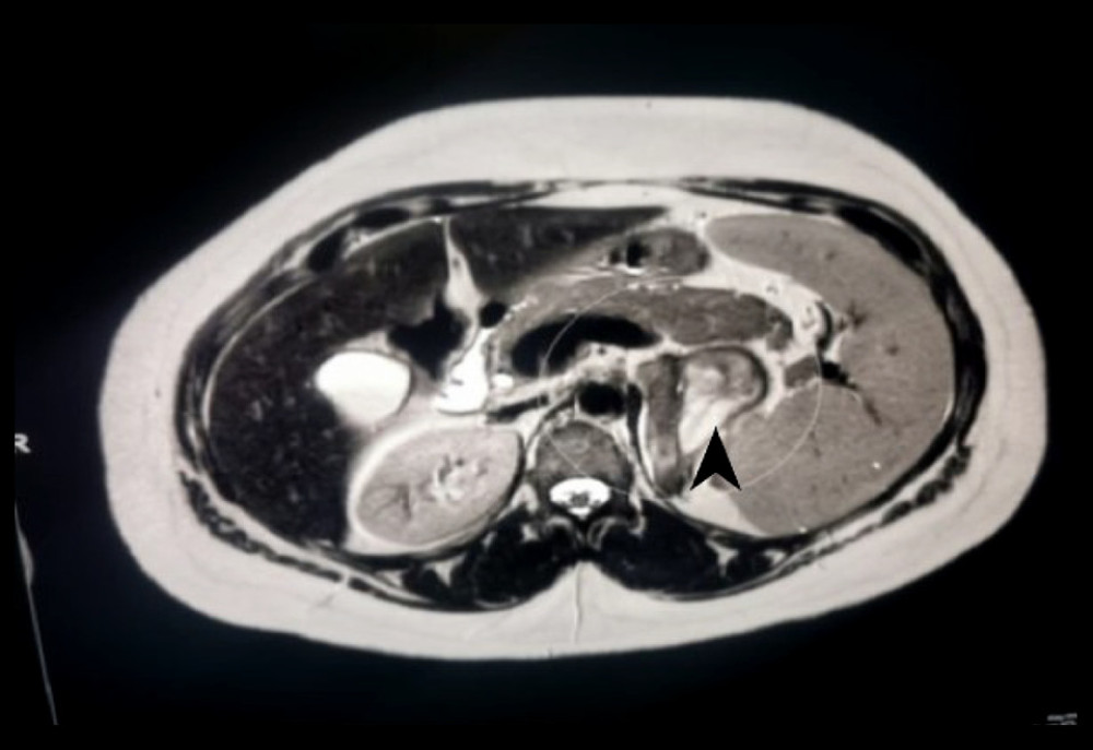 Magnetic resonance imaging in axial T2-weighted sequence showing a large triangular mass of mixed low and high T2 signal intensity (solid and cystic components) replacing the left adrenal gland.