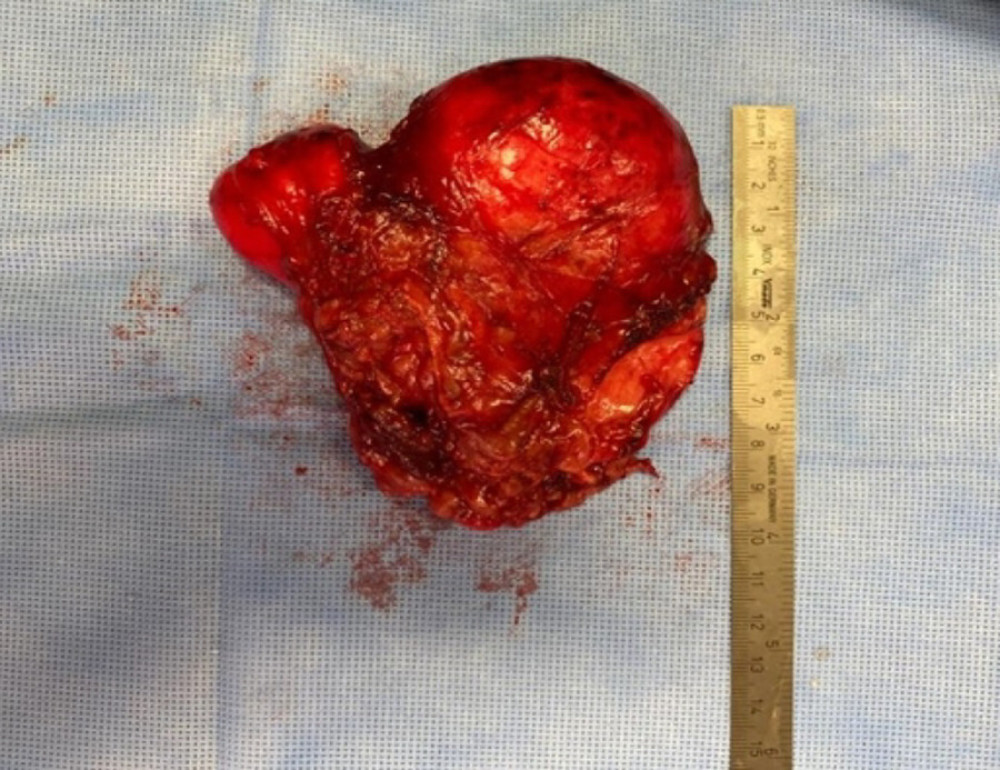 Intraoperative image showing the resected mass after laparoscopic adrenalectomy.