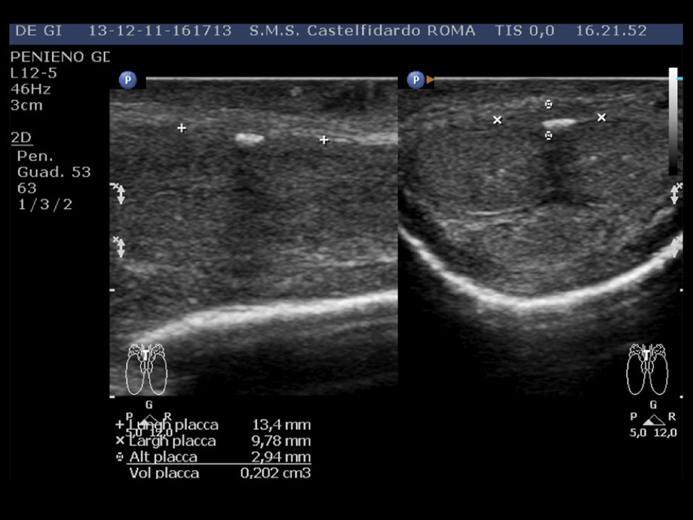 Penile ultrasound and plaque measurement prior to treatment (longitudinal and transverse scan).