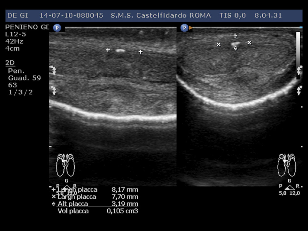 Penile ultrasound after the first 6-month treatment cycle (longitudinal and transverse scan).