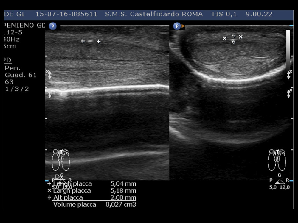 Penile ultrasound after the 2nd (12 month) treatment cycle (longitudinal and transverse scan).