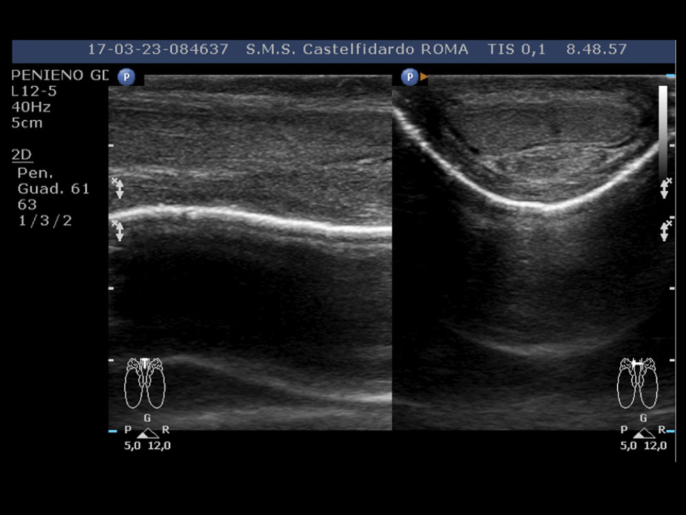 Penile ultrasound after the 4th cycle of treatment (exclusive oral therapy and topical gel) (longitudinal and transverse scan).