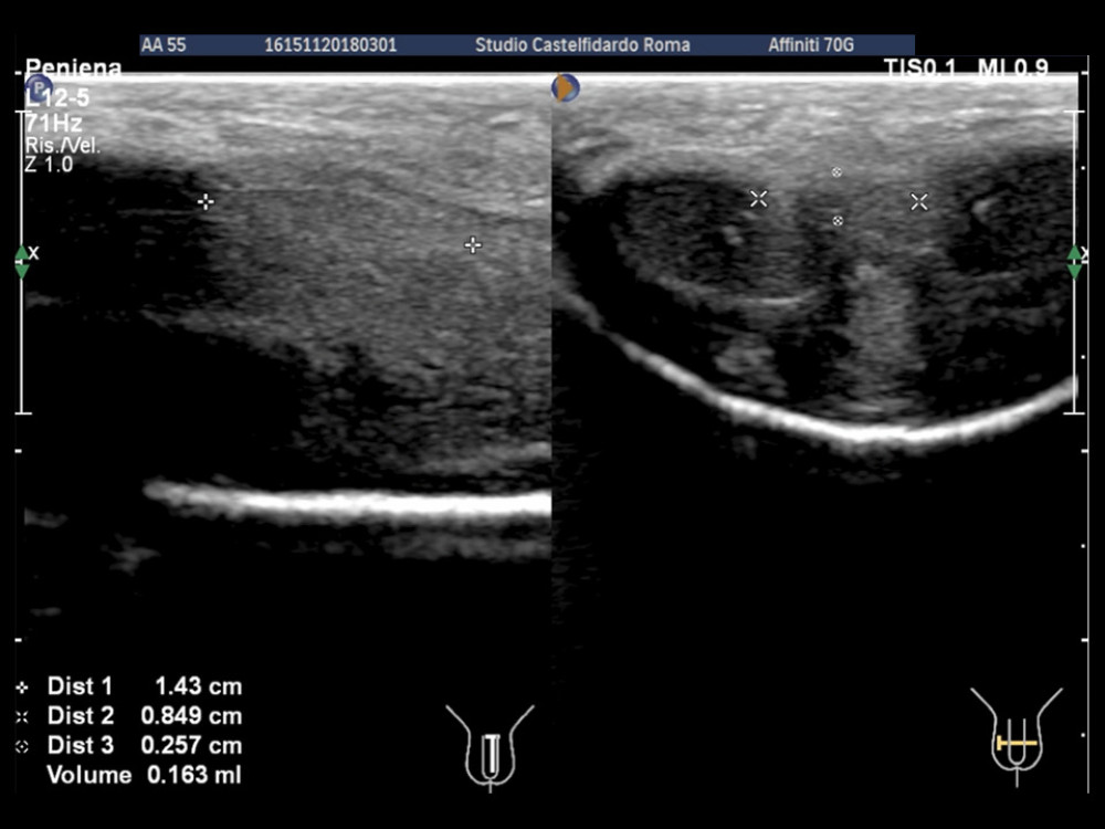 Penile ultrasound and plaque measurement prior to treatment (longitudinal and tranverse scan).