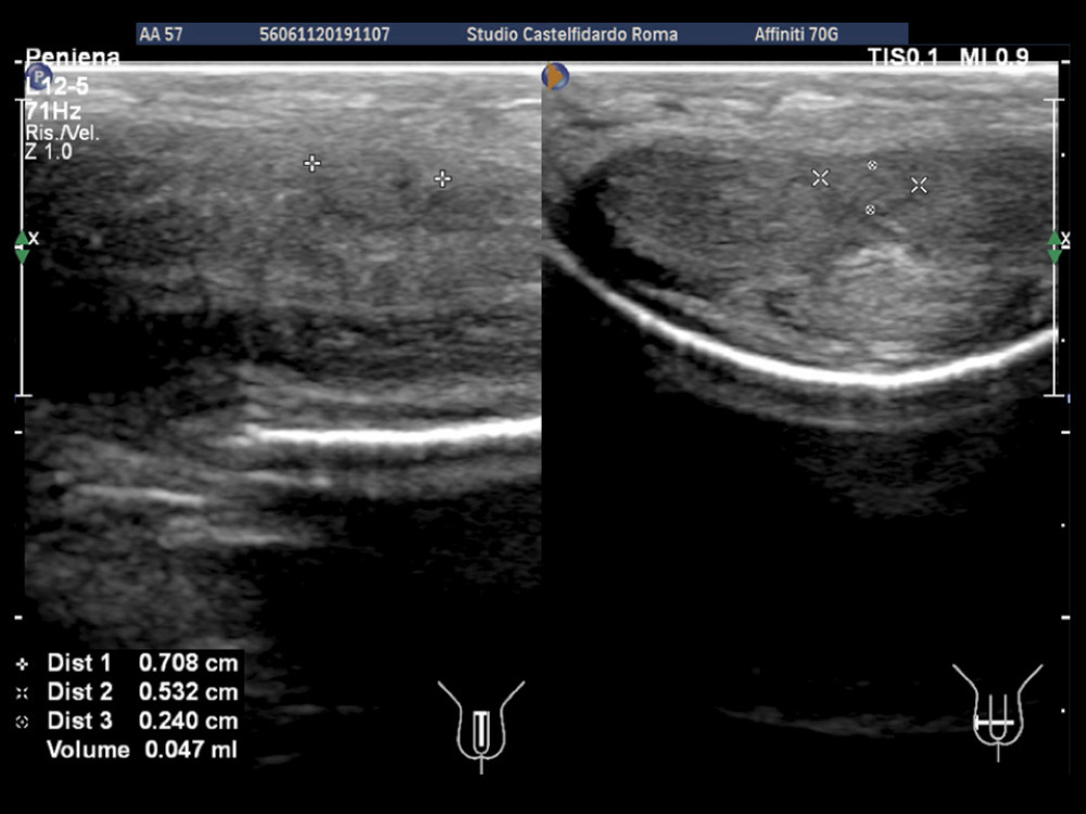 Penile ultrasound after the 2nd (12 month) treatment cycle (longitudinal and transverse scan).