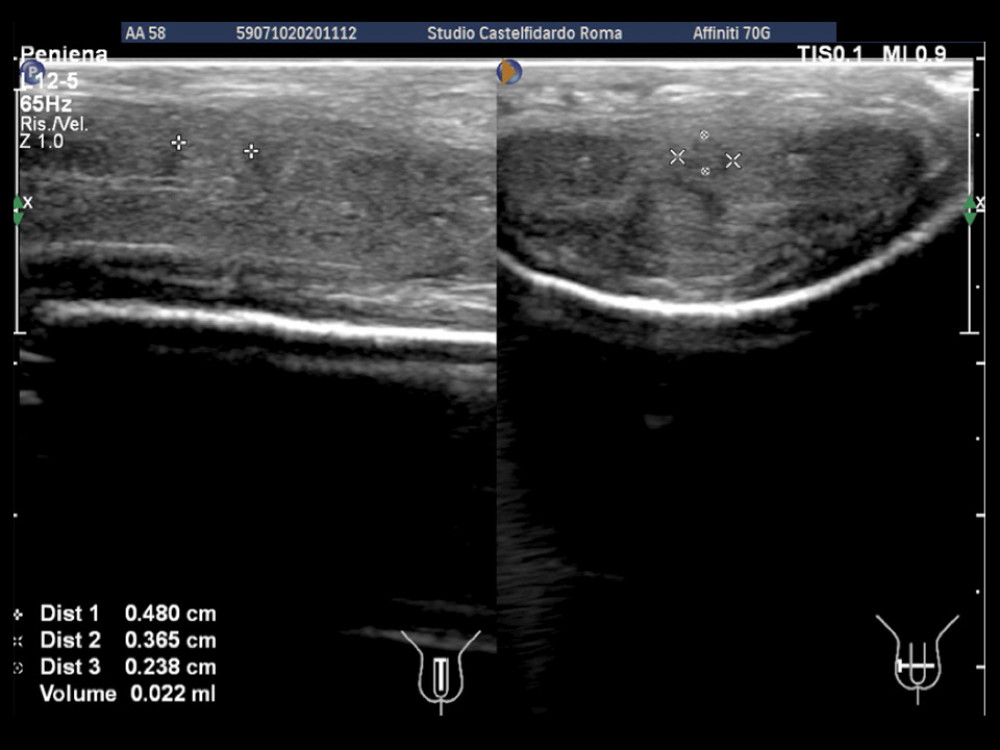 Penile ultrasound after the 3rd (12 month) treatment cycle (longitudinal and transverse scan).