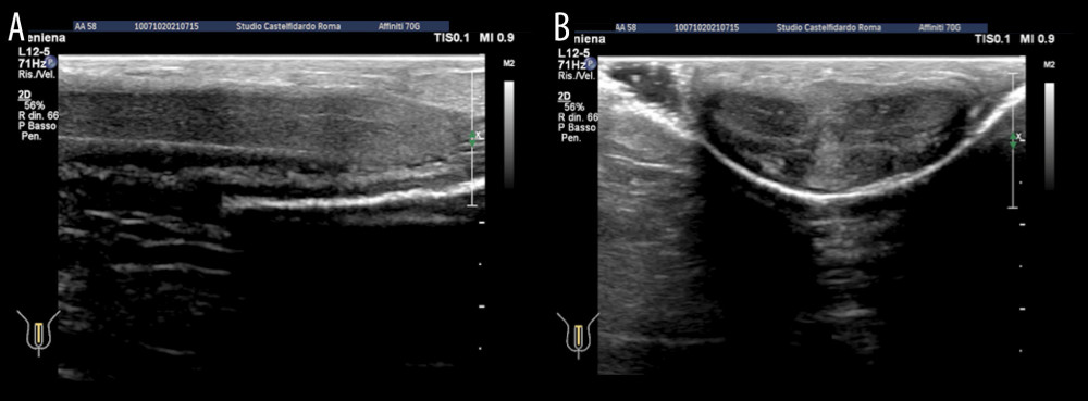 (A) Penile ultrasound after the fourth treatment cycle (longitudinal scan). (B) Penile ultrasound after the fourth treatment cycle (transverse scan).
