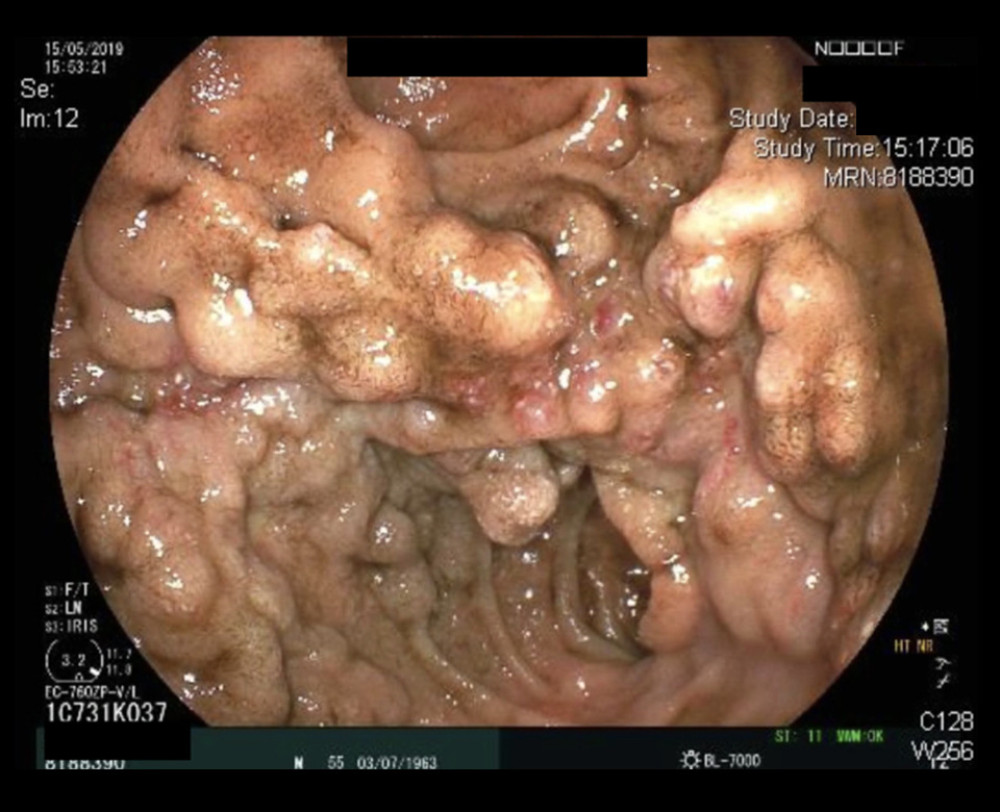 Jejunal varices with red spots but without clear localization of a focus of hemorrhage in the area of the anastomosis after pancreas-kidney transplantation at 100 cm from the oral cavity.