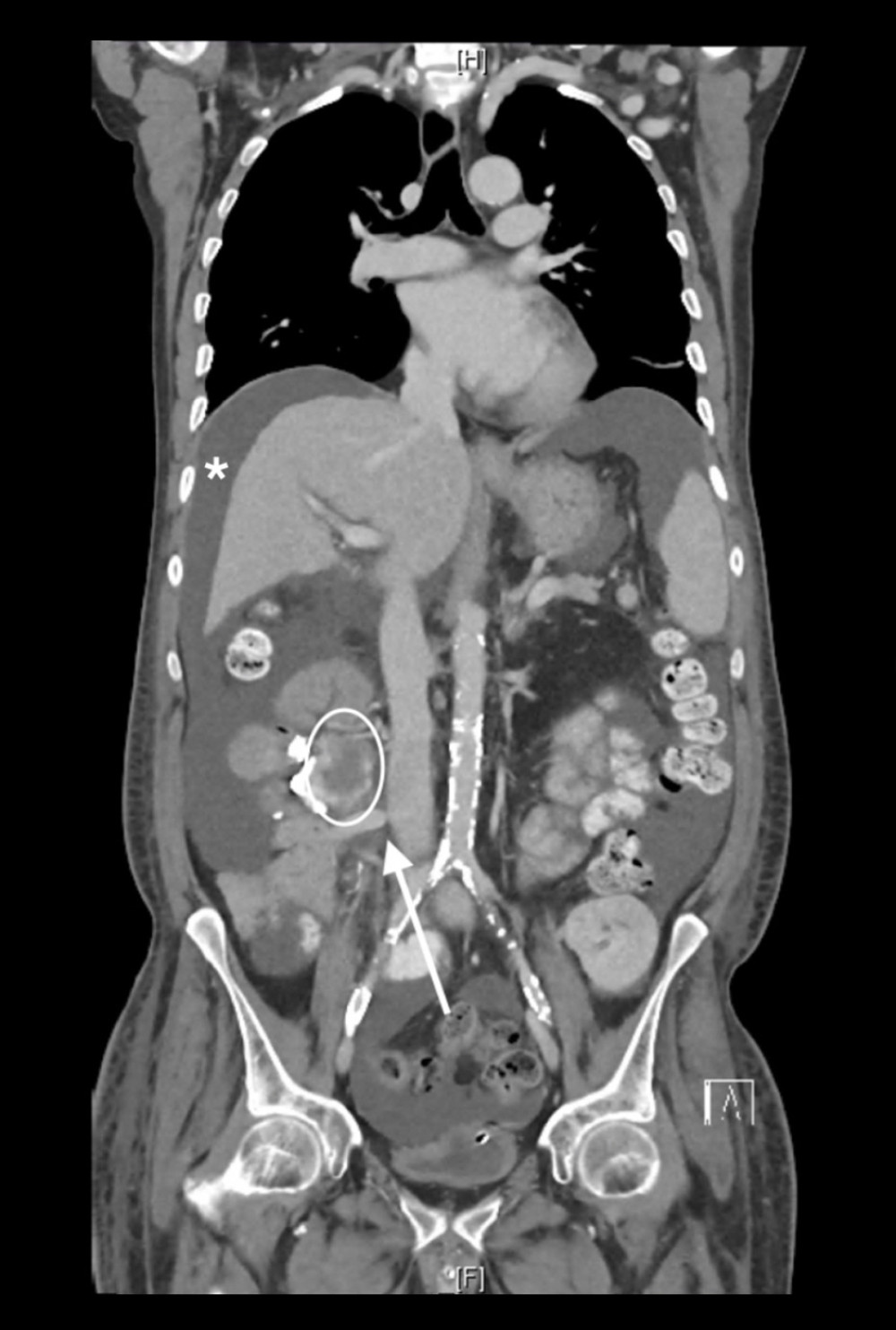 Stenosis of the portosystemic anastomosis of vena cava inferior (arrow). Pronounced jejunal varices in the donor’s duodenum (ellipse) after pancreas-kidney transplantation. Asterisk shows ascites.