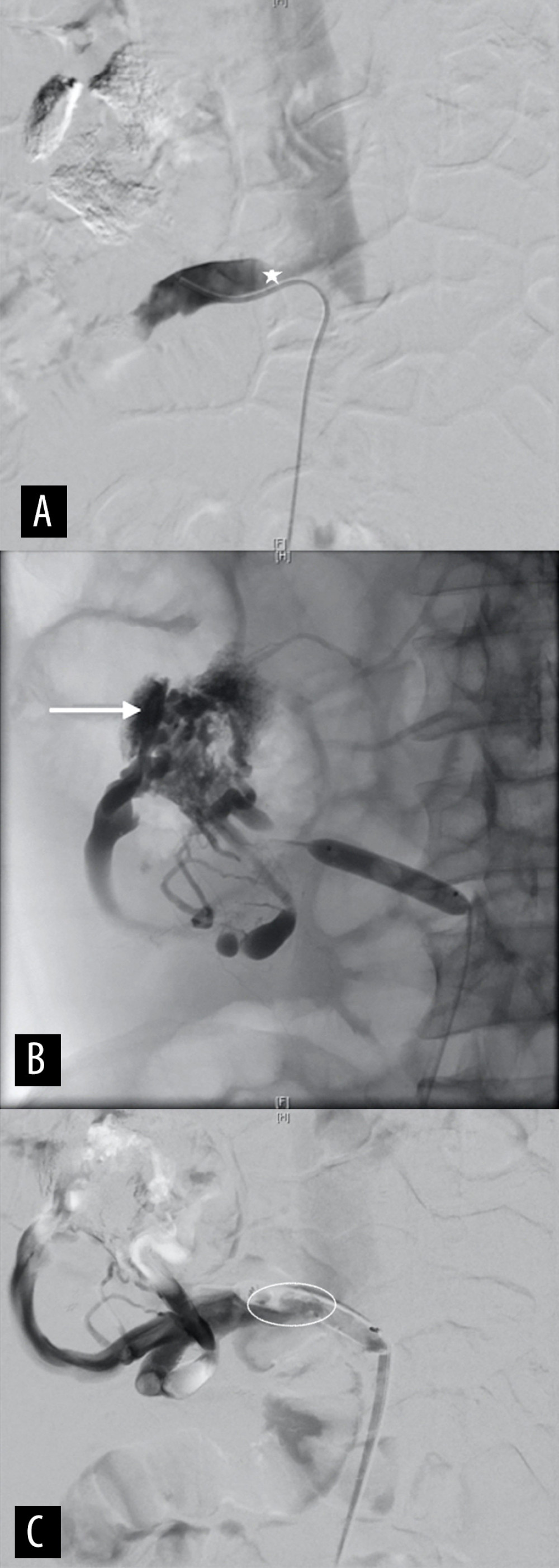 (A) Angiographic dilatation of the portosystemic anastomosis of vena cava inferior with a balloon after pancreas-kidney transplantation. Image of the stenosis (asterisk). (B) Angiographic dilatation of the portosystemic anastomosis of vena cava inferior with a balloon after pancreas-kidney transplantation. Image of the jejunal varices (arrow). (C) Angiographic dilatation of the portosystemic anastomosis of vena cava inferior with a balloon after pancreas-kidney transplantation. Dilatation of the stenosis with a balloon (ellipse).