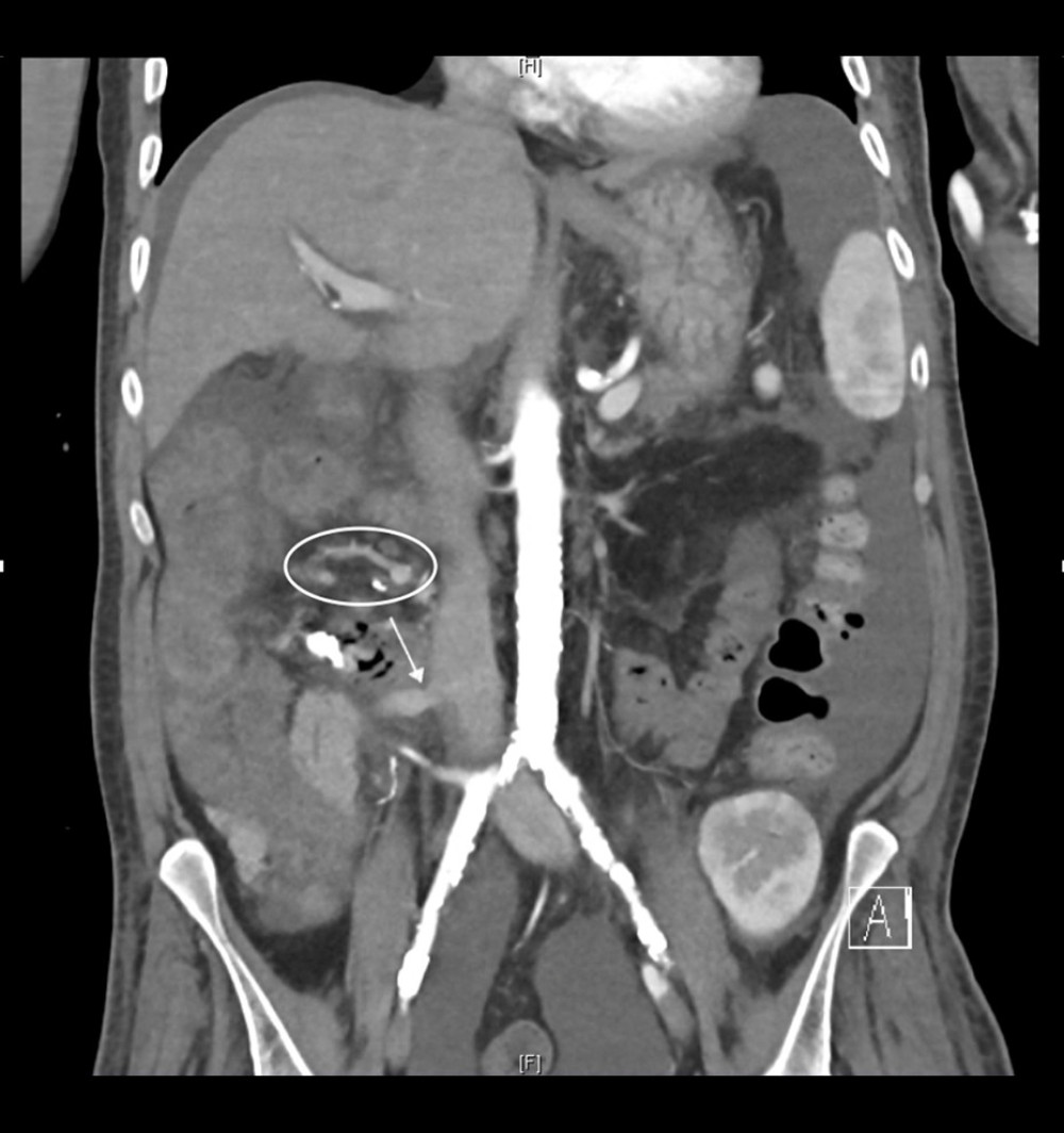 Post-angiographic computed tomography scan. Regressive portosystemic stenosis at the anastomosis at the vena cava inferior (arrow). Persistent jejunal varices in the area of the donor’s duodenum after pancreas-kidney transplantation (ellipse).