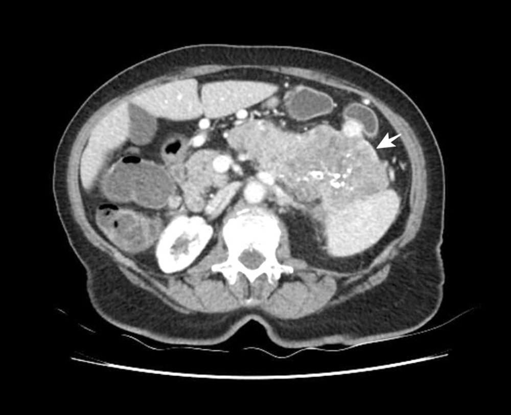 Axial CT scan showing the masses of the pancreatic body and tail.