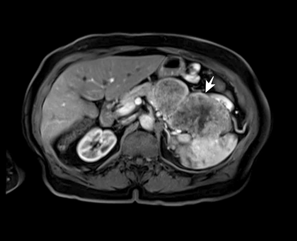 Axial pancreatic MRI (T1) showing the lesion of the pancreatic body and the larger lesion of the pancreatic tail, with invasion of the spleen.